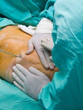 Cirugía de liposucción y banda gástrica